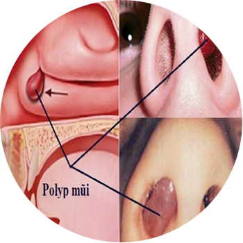 Polip mũi